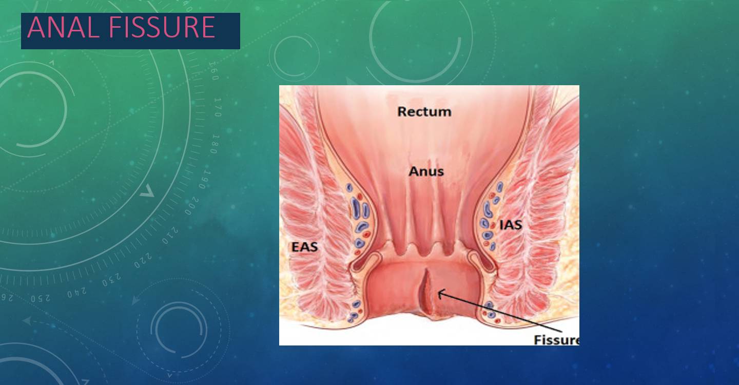 Anal Fissure