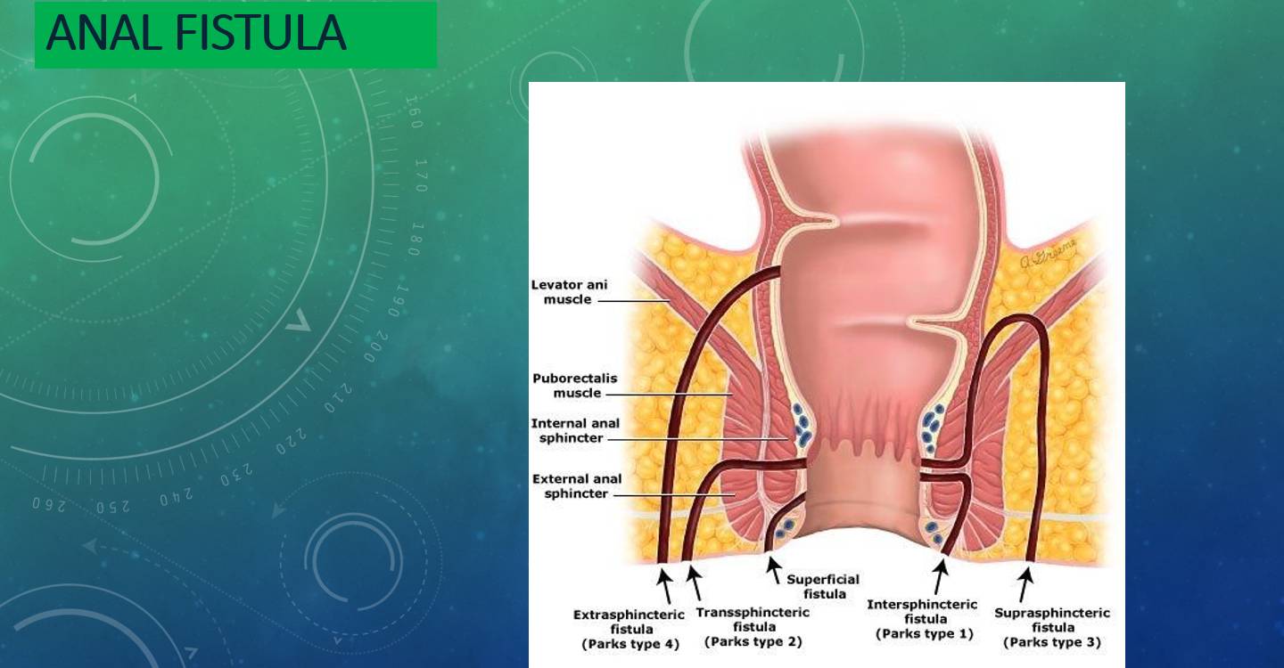 Anal Fistula