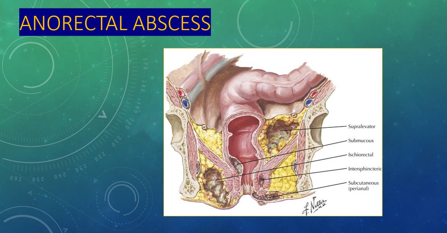 Anorectal Abscess