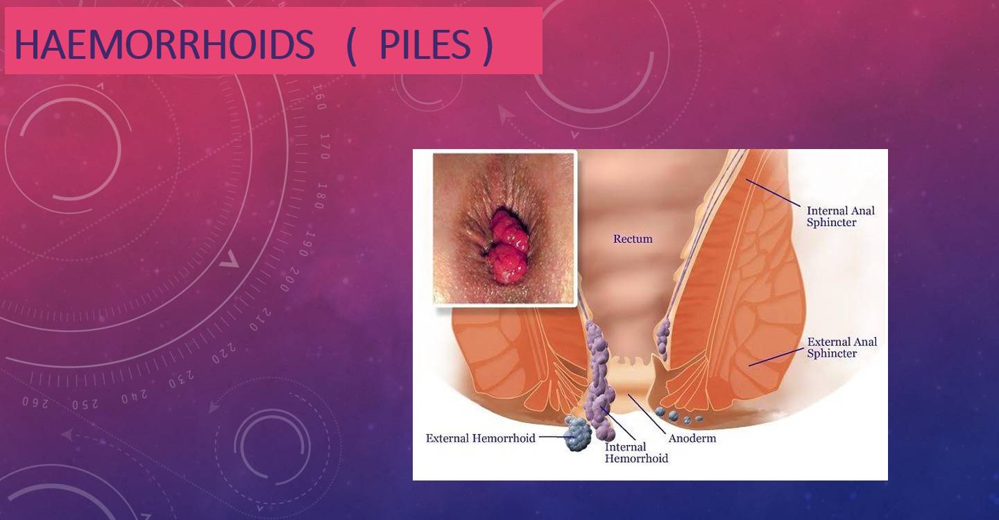 Haemorrhoids (Piles)