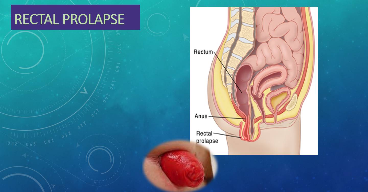 Rectal prolapse