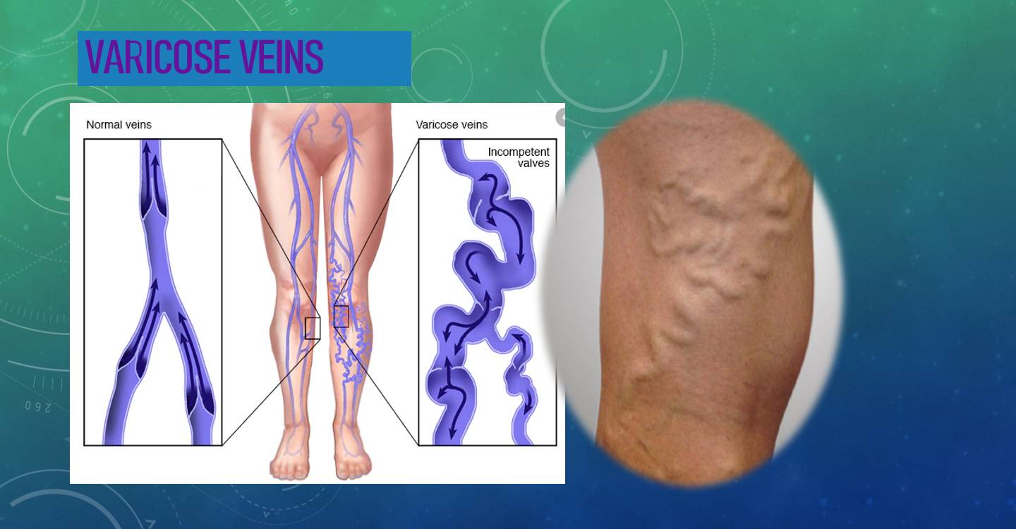 Varicose Veins