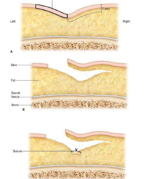 Bascom cleft lip repair.jpg