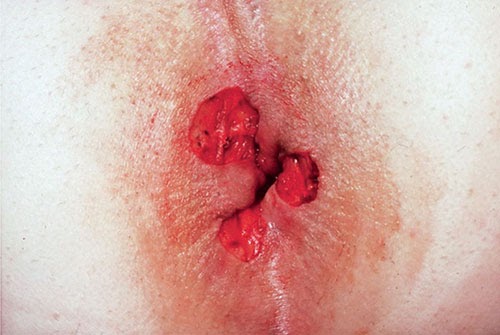 CONVENTIONAL HEMORRHOIDECTOMY WOUNDS