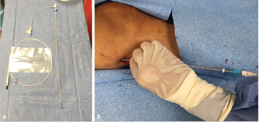 ENDOVENOUS LASER ABLATION KIT AND TECHNIQUE