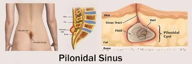 Pilonidal Sinus