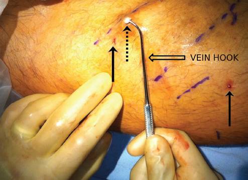 ambulatory phlebectomy.png