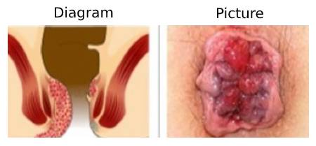 Haemorrhoid grade-1.jpg