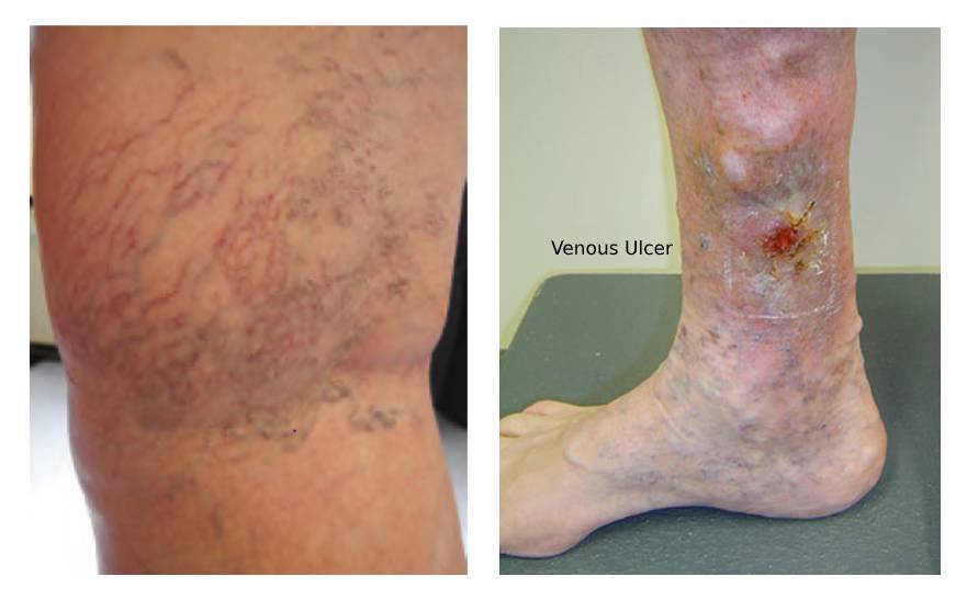 Telangiectasia and reticular veins (left) Venous Ulcer (right)