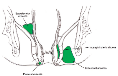 Rectal Abscess