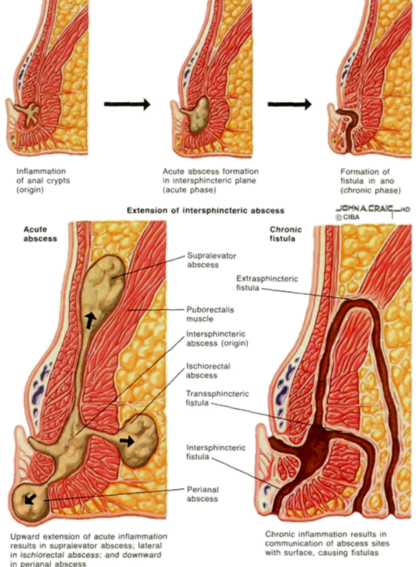 Cryptoglandular Theory of Inter-sphincteric abscess & Fistula formation