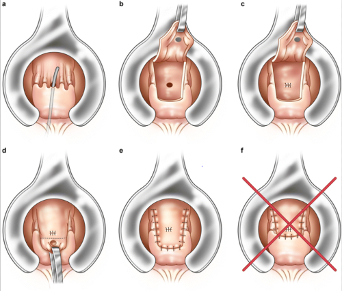 Endorectal advancement flap