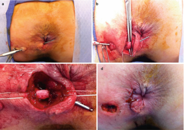 Endorectal advancement flap