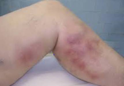 Superficial Thrombophlebitis