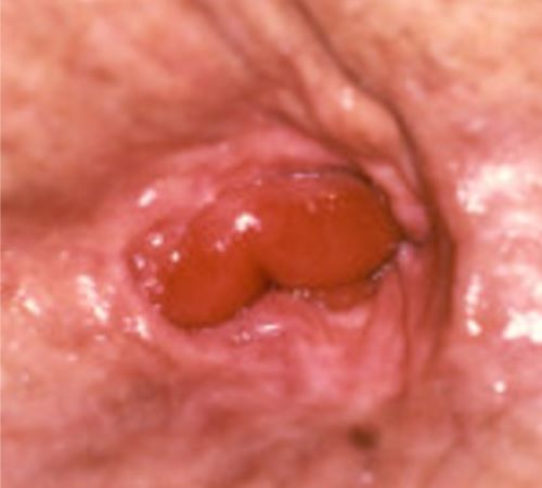 mucosal-prolapse