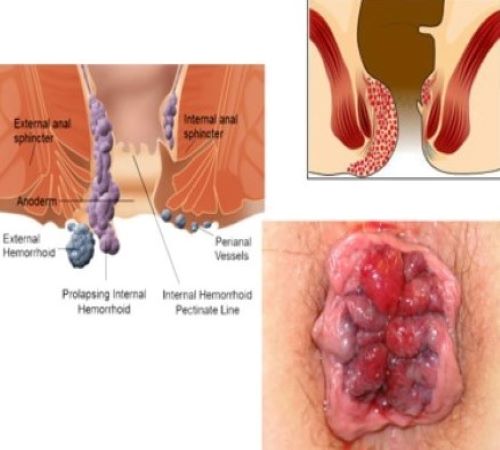 prolapsed-hermorrhoids