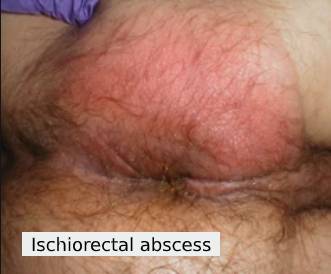 Ischiorectal abscess