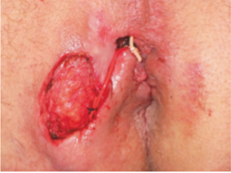 HORSESHOE ABSCESS