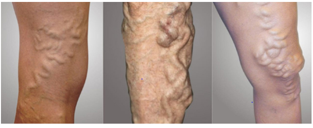 varicose veins