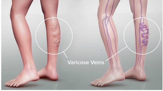 varicose veins