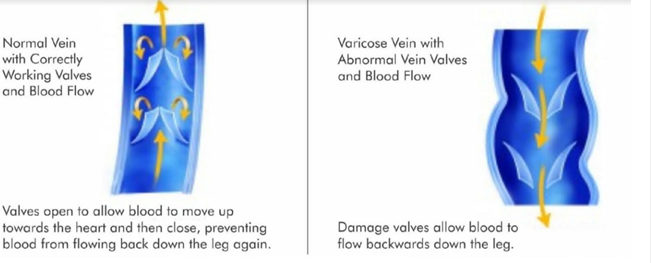 varicose veins